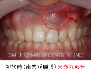 目白マリア歯科_【症例】前歯のセラミック修復による審美的な回復（　前歯部１歯補綴）_術前の腫張部分を示した口腔内写真
